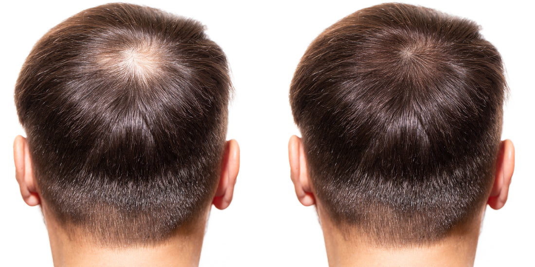 Minoxidil Before and After: Real Stories and Results