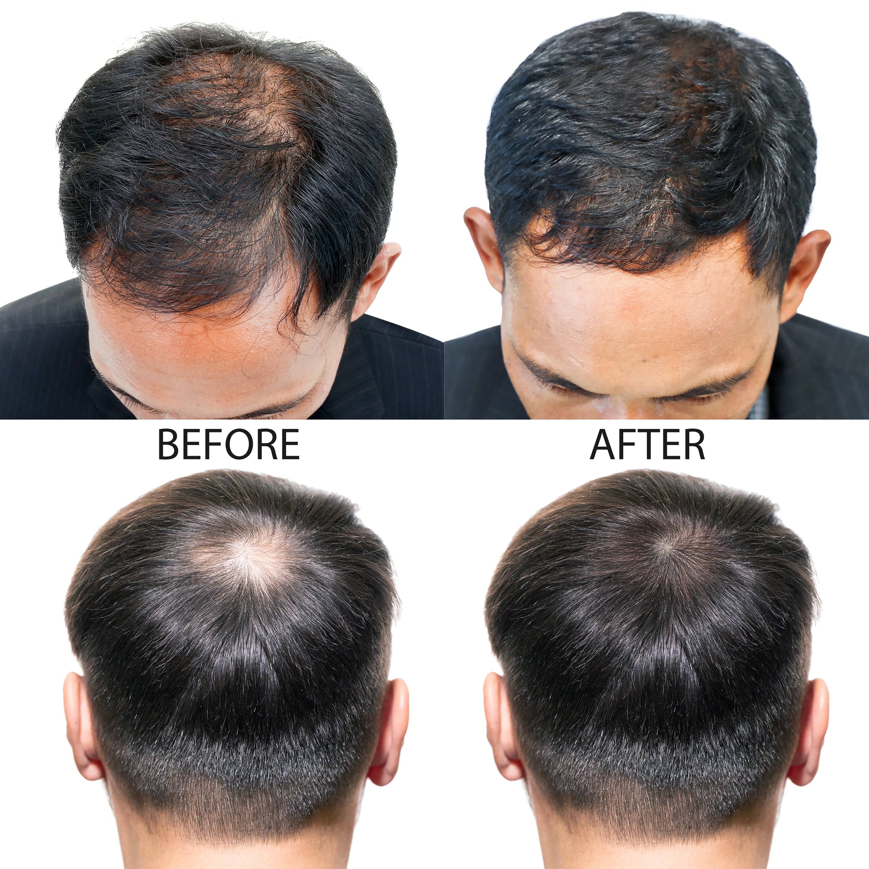 Hair-Regen: 5% Minoxidil Hair Regrowth Treatment for Men