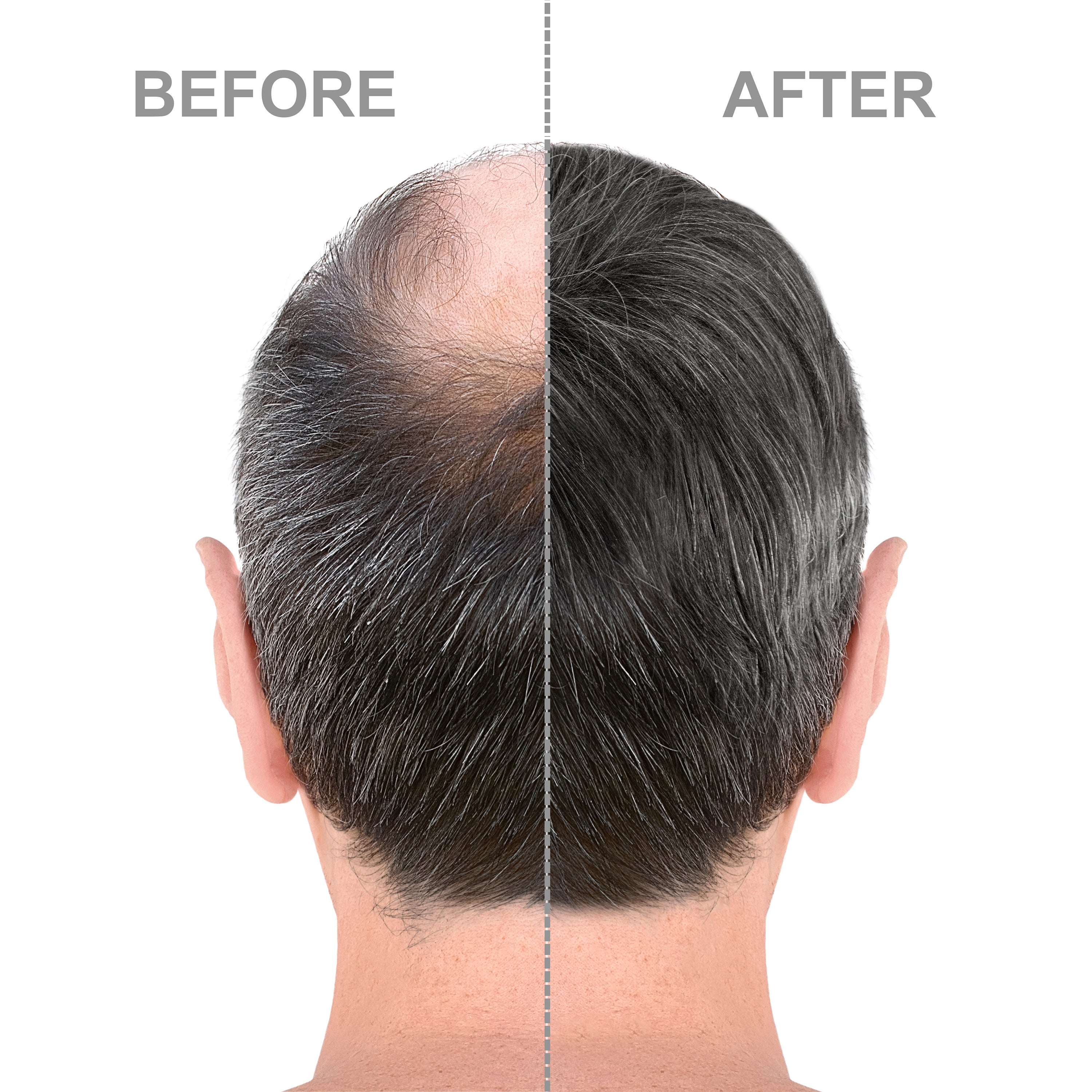 Hair-Regen: 5% Minoxidil Hair Regrowth Treatment for Men